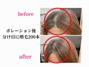 ポレーション後、分け目に増毛２００本