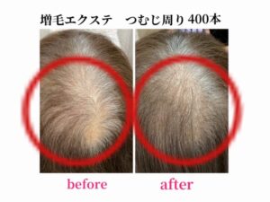 増毛エクステ　つむじ周り400本