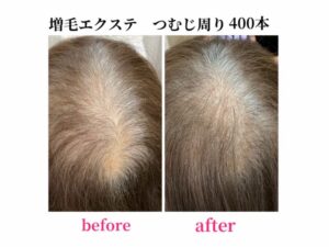 増毛エクステ　つむじ周り400本