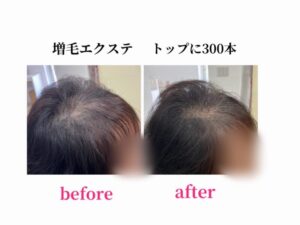 増毛エクステ　つむじ周り300本