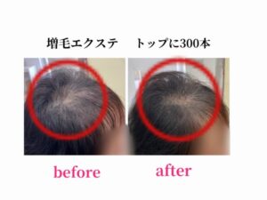 増毛エクステ　つむじ周り300本