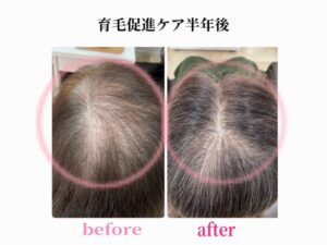 育毛促進ケア半年間