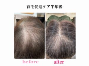 育毛促進ケア半年間