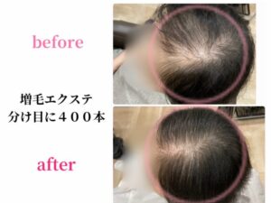 増毛エクステ分け目に４００本