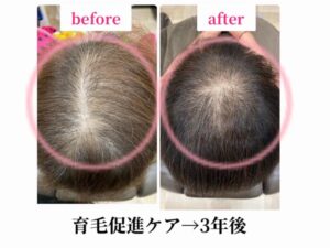 育毛促進ケア→３年後