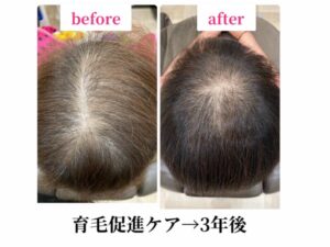 育毛促進ケア→３年後