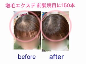 増毛エクステ前髪境目に１５０本