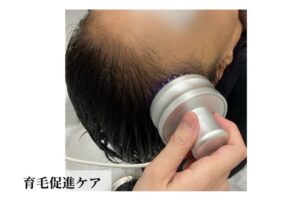 育毛促進ケア